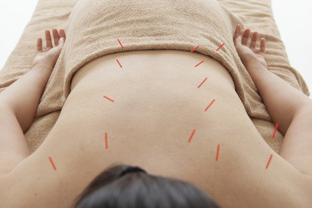 50116044 - asian women are receiving acupuncture treatment of back
